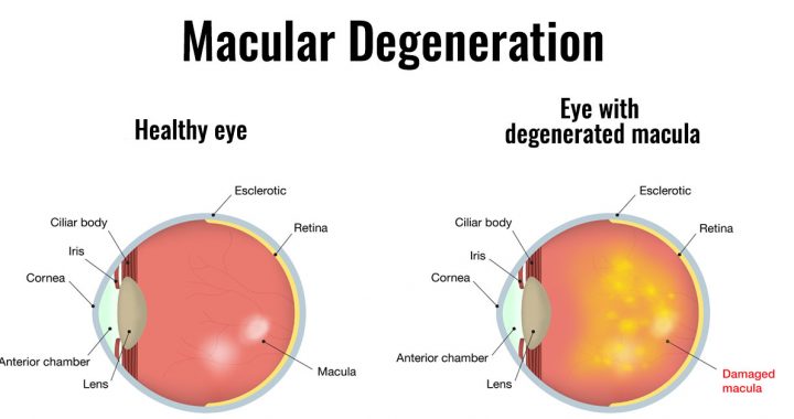 What Is Age Related Macular Degeneration